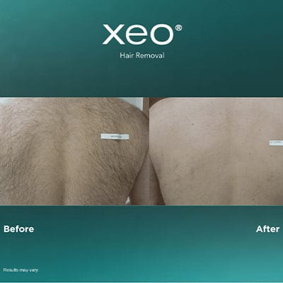 LASER HAIR REMOVAL