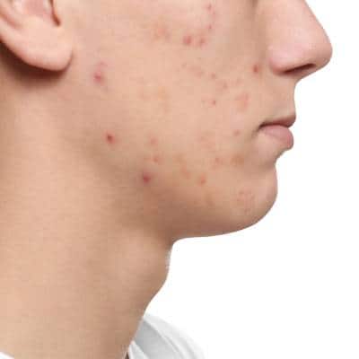ACNE TREATMENTS