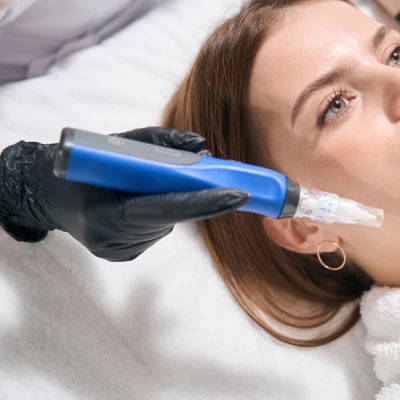 MICRONEEDLING